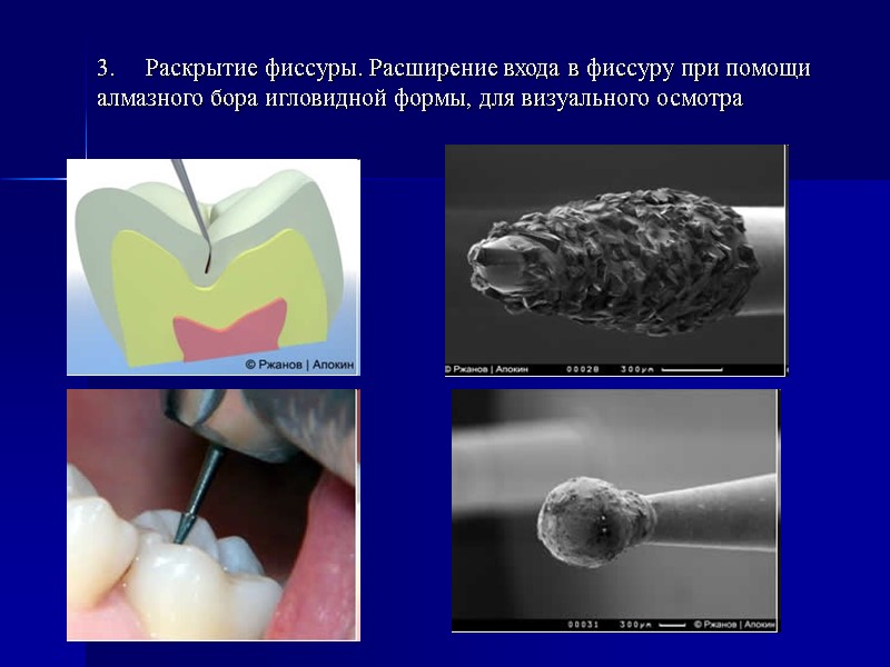 3.     Раскрытие фиссуры. Расширение входа в фиссуру при помощи алмазного